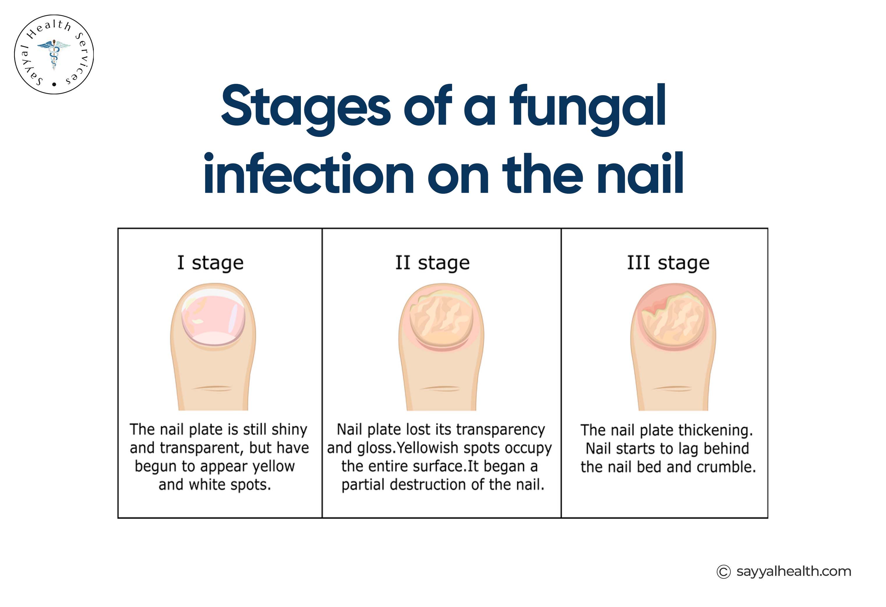 stages of a fungal infection on the nail